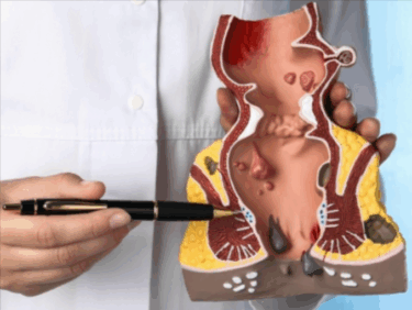 emorroidi interne ed esterne, anatomia